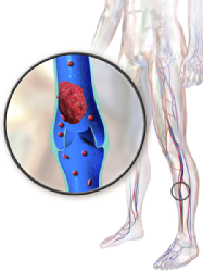 Representación de la trombosis venosa profunda en una pierna